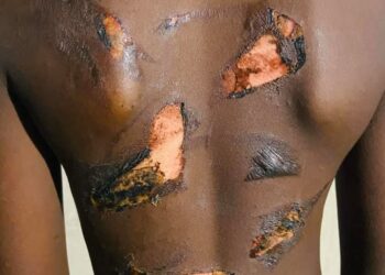 Horreur à Yopougon : un élève brûlé par son oncle à « cause de son excellent résultat scolaire »