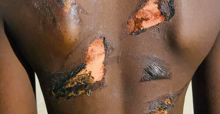 Horreur à Yopougon : un élève brûlé par son oncle à « cause de son excellent résultat scolaire »