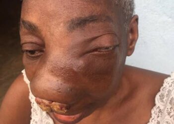 Côte d&rsquo;Ivoire :SOS pour gnogbo mombie Solange 3 millions de fcfa pour lui sauver la vie