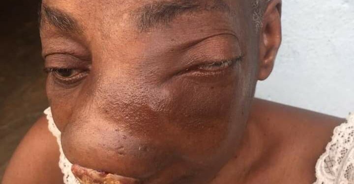 Côte d’Ivoire :SOS pour gnogbo mombie Solange 3 millions de fcfa pour lui sauver la vie