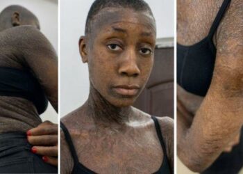 (Interview) Côte d’Ivoire/L’Ichtyose: Brahiman Sidibé présente ce mal méconnu