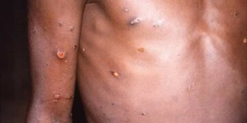 Variole de Singe/point au 11 septembre : 49 cas confirmés dont 43 guéris et 5 en cours de traitement