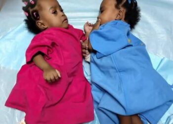 Séparation des siamoises : Un succès grâce à un plateau technique ivoirien performant