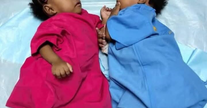 Séparation des siamoises : Un succès grâce à un plateau technique ivoirien performant